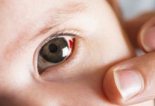 Subkonjungtiva pada anak Sumber birthinjuryguide