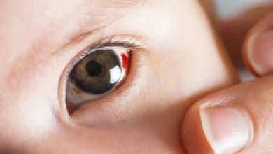 Subkonjungtiva pada anak Sumber birthinjuryguide