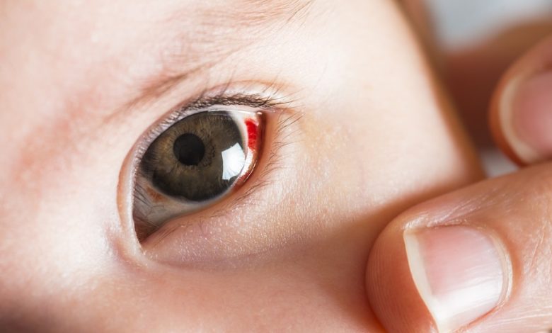 Kenali Tanda Darah Tinggi di Mata Sebelum Terlambat Subkonjungtiva pada anak Sumber birthinjuryguide