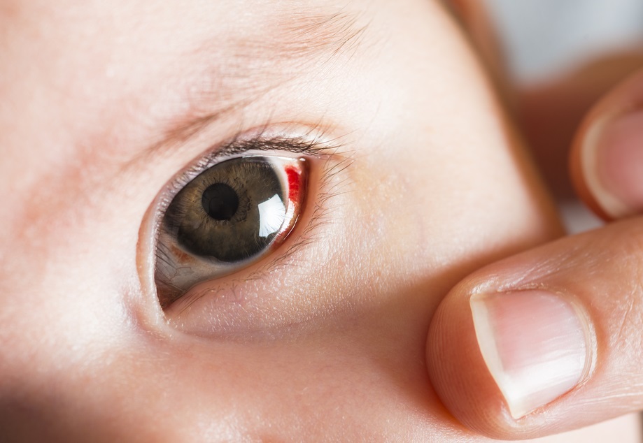 Subkonjungtiva pada anak Sumber birthinjuryguide